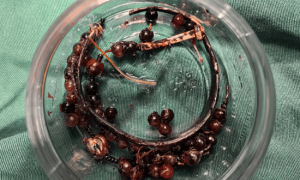 女子手镯10年没摘竟“长”进肉里！医生：再晚点可能危及生命